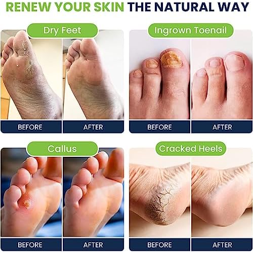 Tea Tree Oil & Soothing Lavender Foot Soak with Epsom Salt - Best Toenail Treatment & Softens Calluses & Toe Nail Repair Solution