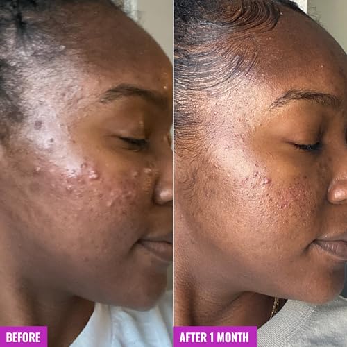 Good Molecules Acne Foaming Cleanser - 2% Salicylic Acid Foam Cleanser - Gentle Acne Face Wash with Alcohol Free Witch Hazel and Aloe - Skin Care for Face