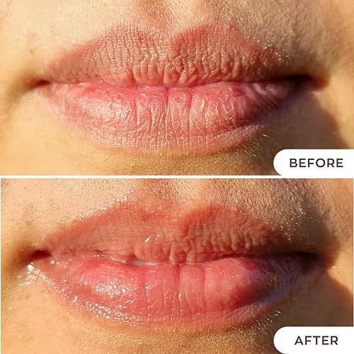 Cystic Acne Treatment for Face ? Hormonal Acne Spot Treatment Pimple Cream with Azelaic Acid | Redness Reducing Acne Moisturizer for Rosacea & Sensitive, Acne-Prone Skin | Teens & Adults, 1.7 oz