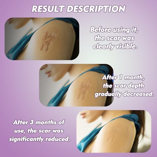 Rayyl Silicone Scar Sheets (1.6" x 60" Roll - 1.5M) - Advanced Silicone Scar Tape Roll Skin-Safe Flexible Strips for Smoother Looking Skin C-Section Recovery Everyday Scars Reusable Value Pack
