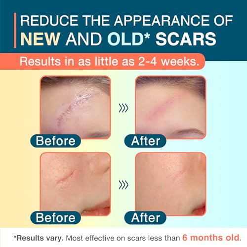 Silicone Scar Sheets, 1.55¡± x 78¡± - 2M Roll, Reusable Silicone Scar Tape, Medical Scar Strips for C-Section, Keloid Bump, Stretch Marks, Burn, Acne, Tummy Tuck, Surgical Scar Removal