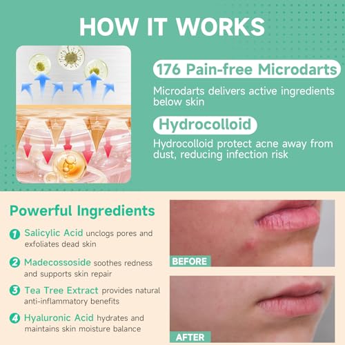 36P Microdart Acne Patches, Hydrocolloid Pimple Patches with Salicylic Acid & Madecossoside, Microdart Zit Patches for Deep Blemishes & Early Stage Acne (Patented)