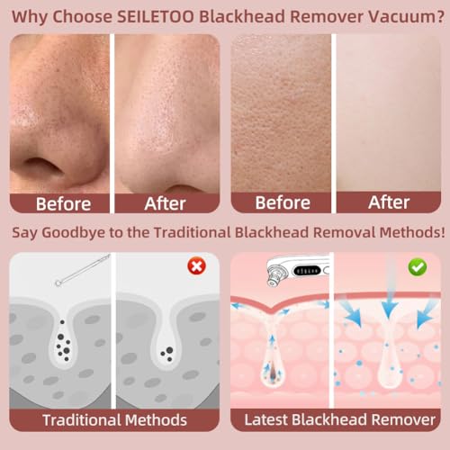 5-Speed ??Blackhead Remover Vacuum, Wireless Charging Nose Pore Extractor with 4 Removable Heads,Facial Vacuum Pore Cleaner,30-Second Keratin Softening, Hypoallergenic Deep Cleansing
