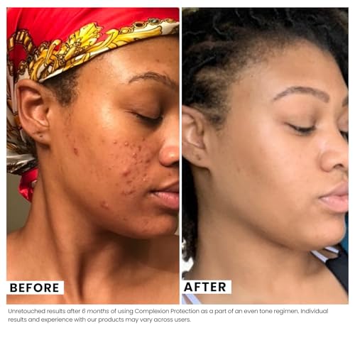 Urban Skin Rx¢ç Complexion Protection Even Tone SPF30 Moisturizer, Sheer, Lightweight, Non-Pore Clogging Cream Hydrates & Provides Sun Protection, With Squalane, Hyaluronic Acid & Vitamin E, 1.7 Oz
