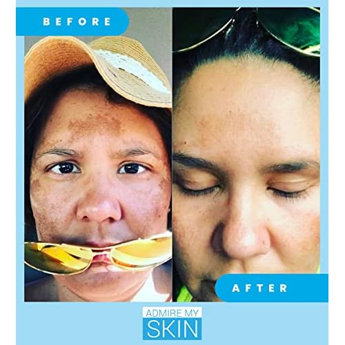 Admire My Skin Dark Spot Remover + Retinoid Cream + Vitamin C Oil