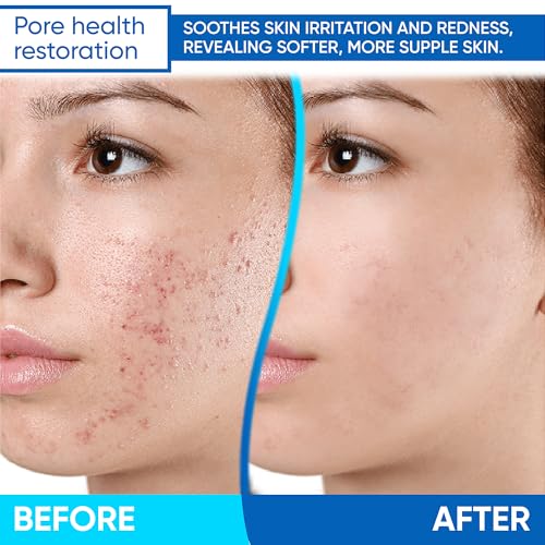 Azelaic Acid Cream: Azelaic Acid For Face - Premium Azelaic Acid Cream - Face Skin and Beauty Care - Azelaic Acid Facial Cream (1 Oz)
