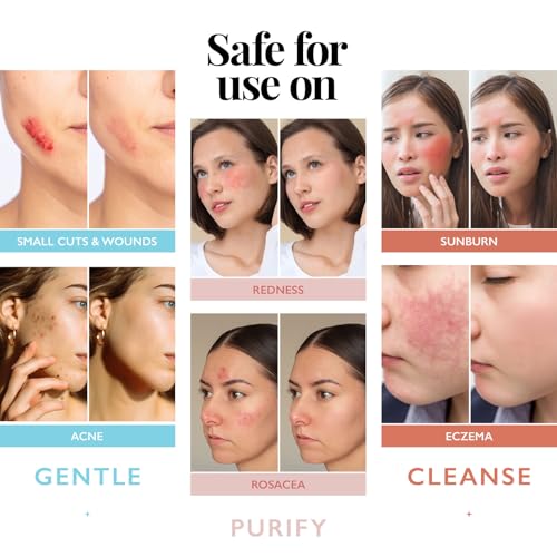 Hypochlorous Acid Spray for Face and Skin; Facial Cleanser | 8oz Face Mist Hypochlorous Acid Spray for Skin, Acne, Rash, Eczema, Wound | Antimicrobial Facial Cleanser Acne Sprays; Smart Skincare