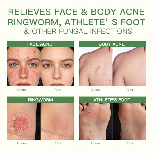 Tea Tree Soap, Tea Tree Soap Bar for Face & Body, Antifungal Soap with Tea Tree Oil, Antibacterial Bar Soap for Fungus, Ringworm, Acne, Pack of 3