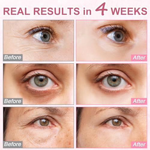5% Caffeine Eye Serum Treatment,Hyaluronic Acid & Niacinamide, Under Eye Cream for Dark Circles, Anti Aging 360¡Æ Massage Rollerball - Reduce Puffiness, Wrinkles & Fine Lines, 0.5 fl. oz