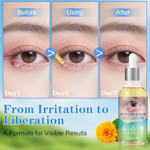 Stye Eye Relief Serum & Eyelid Drops for Blepharitis, Chalazion Styes Redness | Under Eye Serum Natural, Stye Drops for Infected Eyes Fast-Acting | Gentle Care 30ml