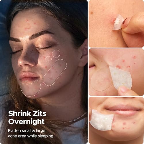 LitBear Pimple Patches for Face, 400 Counts Day and Night Acne Patches, Hydrocolloid Patches for Covering Zit and Blemishes, Large Breakouts, 5 Sizes Thin & Thick Spot Dots Stickers for Chin, Forehead