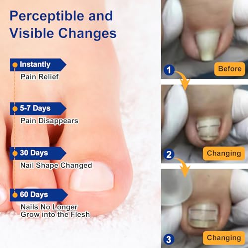 Nitinol Ingrown Toenail Corrector,at Home Ingrown Toenail Treatment,Curved Toenail Straightener,Ingrown Toe Nail Relief£¬Ingrown Toenail Removal Kit (1/2 In,11/16 In)