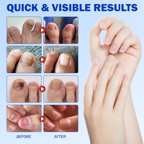 Fungal Nail Patches 42 PCS, Toenail Treatment Extra Strength 8-Hour Overnight Nail Fast Acting Repair Effortless Hydrogel Nail Care and Repair for Damaged Nails Overnight Renewal for Men and Women