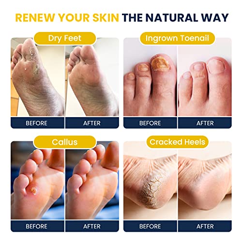 Citrus Detox Foot Soak With Epsom Salts - for Foot Callus, Immune Boost, Damaged Toenail, Athletes Foot, Pedicure & Toenail Repair Liquid