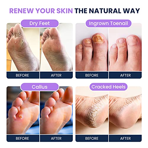 Soothing Lavender Foot Soak with Epsom Salt - Best Toenail Treatment, & Softens Calluses - Soothes Sore & Tired Feet, Toenail Extra Strength Solution