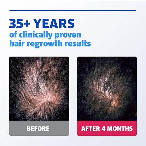 Men¡¯s Rogaine Extra Strength 5% Minoxidil, Topical Solution for Thinning & Hair Loss, Clinically Proven FDA Approved Minoxidil for Men Treatment, Regrow Fuller Hair, 3 Month Supply, 3 Bottles