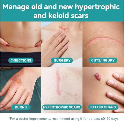 Dimora Medical Grade Silicone Scar Sheets - Ultra Soft Silicone Scar Tape (1.6¡±x120" Roll), Waterproof Scar Treatment for Surgical Scars, C Section, Tummy Tuck, Keloid Treatment