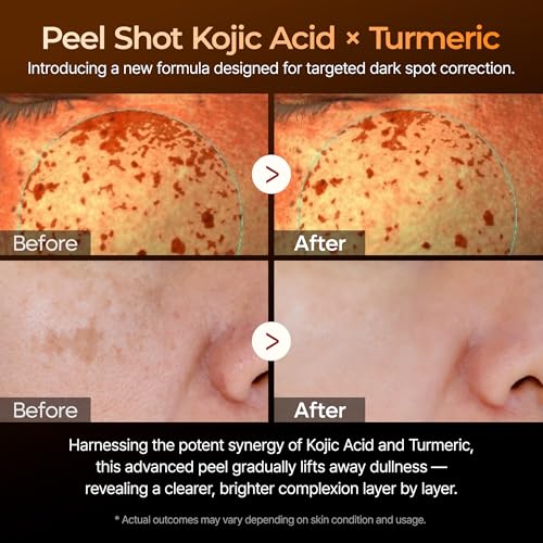 Dr. Melaxin Peel Shot Kojic Acid Turmeric Serum ? Exfoliating Dark Spot Corrector with AHA/BHA & Niacinamide, Brightening & Even Tone Facial Serum (80ml / 2.70 fl oz)