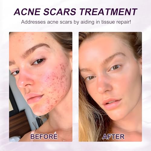 Marianp Hyaluronic Acid Serum for Face- Azelaic Acid 10% Serum for Facial And Skin Care Treatment with Vitamin B3 And B5 for Acne Pimple Pigmentation Blackhead Rosacea Beauty Skincare