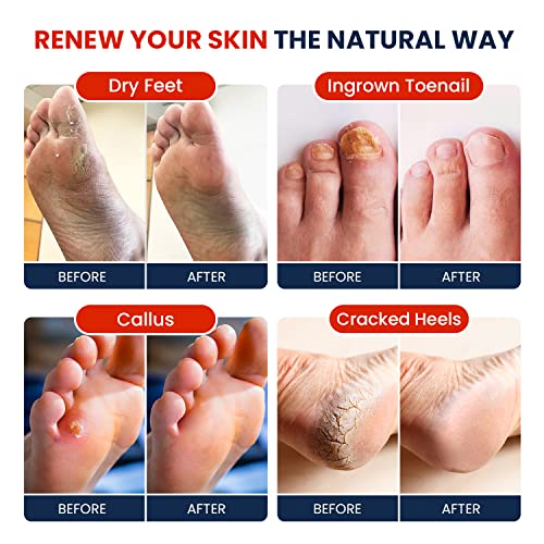 Muscle Relief Foot Soak with Epsom Salts - All Natural Salts for Post Workout - Easy Way to Remove Hard Calluses & Dead Skin Build-Up - Professional at Home Foot Care for Men & Women - Made in The USA