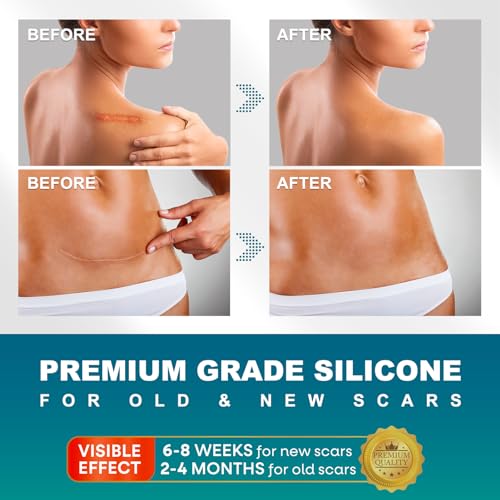 Silicone Scar Sheets, Silicone Scar Tape(1.6"x 120" Roll - 3 Meters) Scar Tape for Surgical Scars, Silicone Tape for Scars, Silicone Scar Strips for C-Section, Tummy Tuck, Keloid, and Surgical Scars