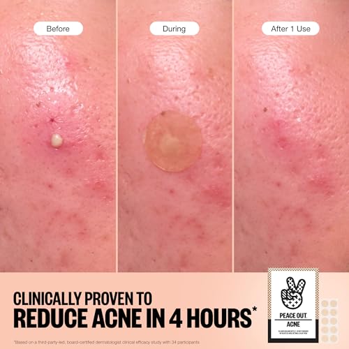 PEACE OUT Acne Healing Dots Hydrocolloid Pimple Patches, Acne Spot Treatment with Salicylic Acid, Retinol, and Aloe Vera for Blemishes and Breakouts, 40 Count