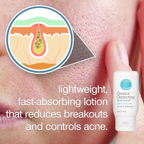 CONTROL CORRECTIVE Clear Med 10% Acne Treatment Lotion, 2.5 Oz - Helps Clear & Control Breakouts, Benzoyl Peroxide, 3% Sulfur To Improve Efficacy And Dry Up Blemishes