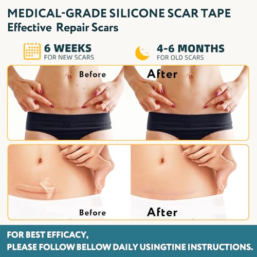 Silicone Scar Tape - 60" x 1.6" Roll - 1.5M, Scar Treatment for Improves Surgical, Keloid, Hypertrophic Scars - Medical Grade Reusable Silicone Scar Sheets