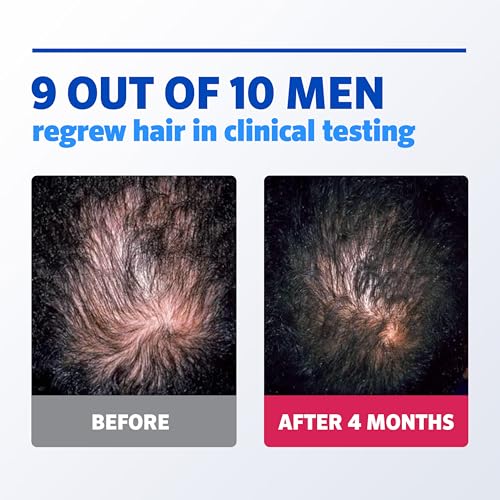 Men¡¯s Rogaine 5% Minoxidil for Men Foam, Clinically Proven Regrowth for Thinning Hair, Topical Hair Loss Treatment, Unscented Topical Aerosol, Results in 8?16 Weeks, 3-Month Supply, 3 x 2.11 oz