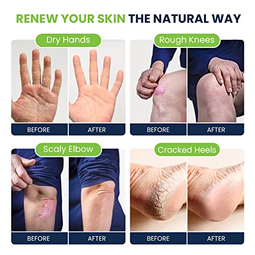 Tea Tree Oil Foot Balm/Moisturizer For Dry Cracked Feet - Instantly Hydrates & Soothes Irritated Skin & Athletes Foot & Tea Tree Oil Foot Cream Heel & Callus Removal, Toenail Treatment