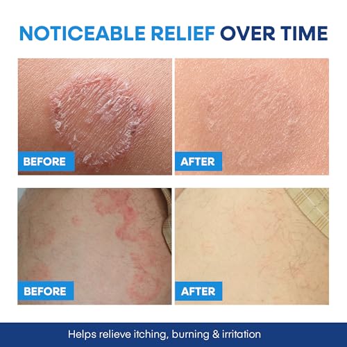 Hermon Jock Itch Antifungal Soap: Antifungal Bar with Tea Tree Oil Soothing Care & Relief of Itching, Burning & Scaling from Jock Itch, Athlete¡¯s Foot & Ringworm ? 2 Bars