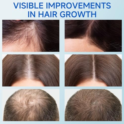 Hair Growth Serum Roll On, Rosemary Oil for Hair Growth, Be Roll On Rosemary Plant Essential Oils Extract Helps Support Body Thicker Fuller Hair for Men Women Wise Pick