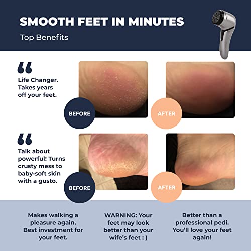 Electric Foot Callus Remover with Vacuum - Own Harmony Professional Pedicure Tools Kit for Powerful Pedi Feet Care Vac, Electronic Foot File CR2100, Best for Hard, Dry, Cracked, Dead Skin (3 Rollers)