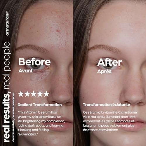 artnaturals Anti-Aging Vitamin C Serum - (1 Fl Oz / 30ml) - with Hyaluronic Acid and Vit E - Wrinkle Repairs Dark Circles, Fades Age Spots and Sun Damage - Enhanced 20% Vitamin C