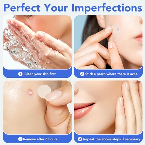 Pimple Patches for Face,Acne Patches for Face,Pimple Patch,Zit Patches,Hydrocolloid Blemish Patches for Covering Zits,with Salicylic Acid,Tea Tree oil & Calendula oil (360 Counts, Count, 360)