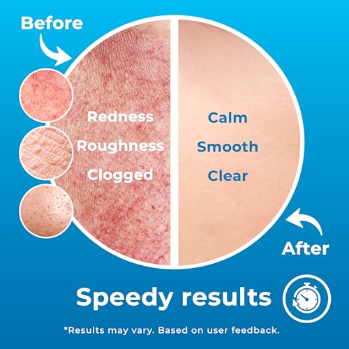 Hypochlorous Acid Spray (8oz, 2 packs), HOCL Facial Cleanser Acne Spray for Face, Body, Eczema, Pimples, Breakouts & Overall Skin Recovery (Reduces Redness)