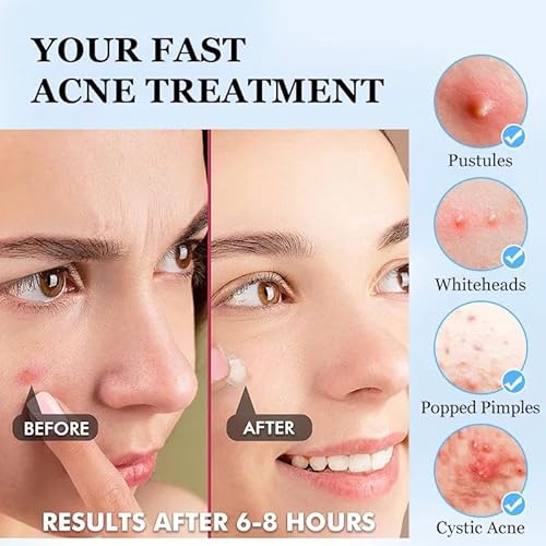 ClearPatch Acne Treatment Hydrocolloid Pimple Patch (36 Patches in 1 Box) ? Invisible Acne Patch for Pimple, Blemish Healing, Skin Protection, Hypoallergenic, Day or Night Use, Unscented