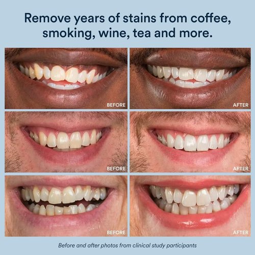 Auraglow 35% Teeth Whitening Gel Syringe Refill Pack, 35% Carbamide Peroxide, 30 Whitening Treatments, (3) 5mL Whitening Gel Syringes, Sensitive Teeth Whitening
