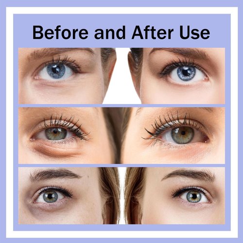 Renewa Eyelift Device, Eye Bag Remover Glasses for Remove Dark Circles, Eyelift Device Bag Remover Quickly Remove, Puffy Eyes Bags in 21 Days, Reduce Fine Lines (#A)