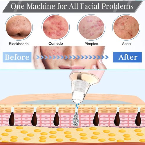 Blackhead Remover Pore Vacuum, Upgraded USB Rechargeable Facial Pore Cleaner Blackhead Removal Kit with 3 Suction Power,5 Probes Black Head Extractions Tool for Women & Men (Pink)