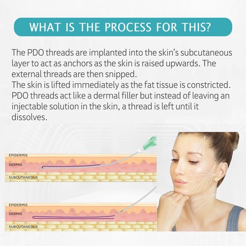 ESTEVO PDO Mono Threads Lift, for Face and Body PDO Thread For Skin Tightening and Reduce Wrinkle (20PCS-27G*60mm)